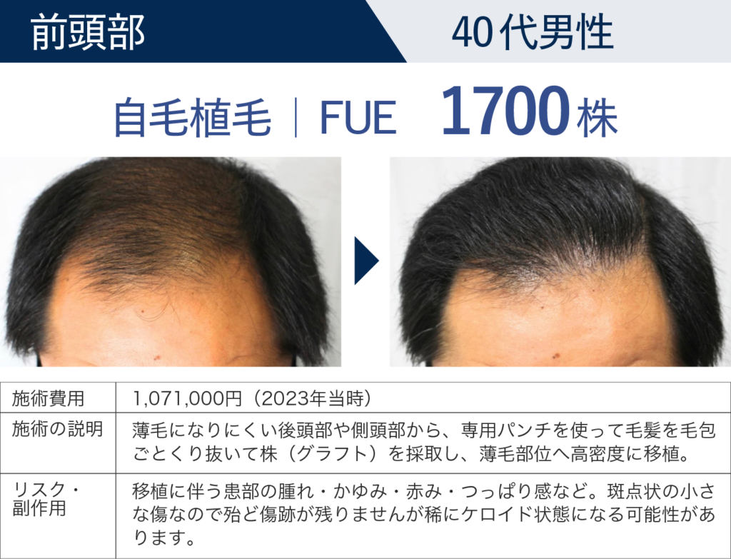 前頭部 40代男性 自毛植毛 FUE 1700株の症例詳細