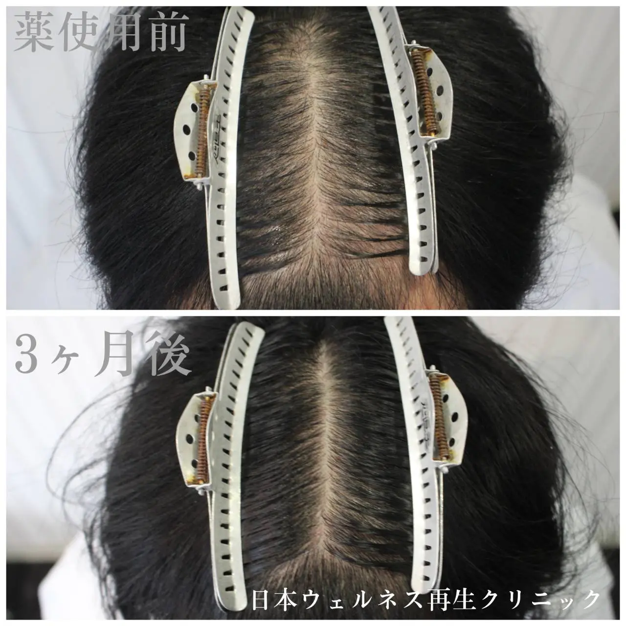 AGA薬剤治療についての記事アイキャッチ