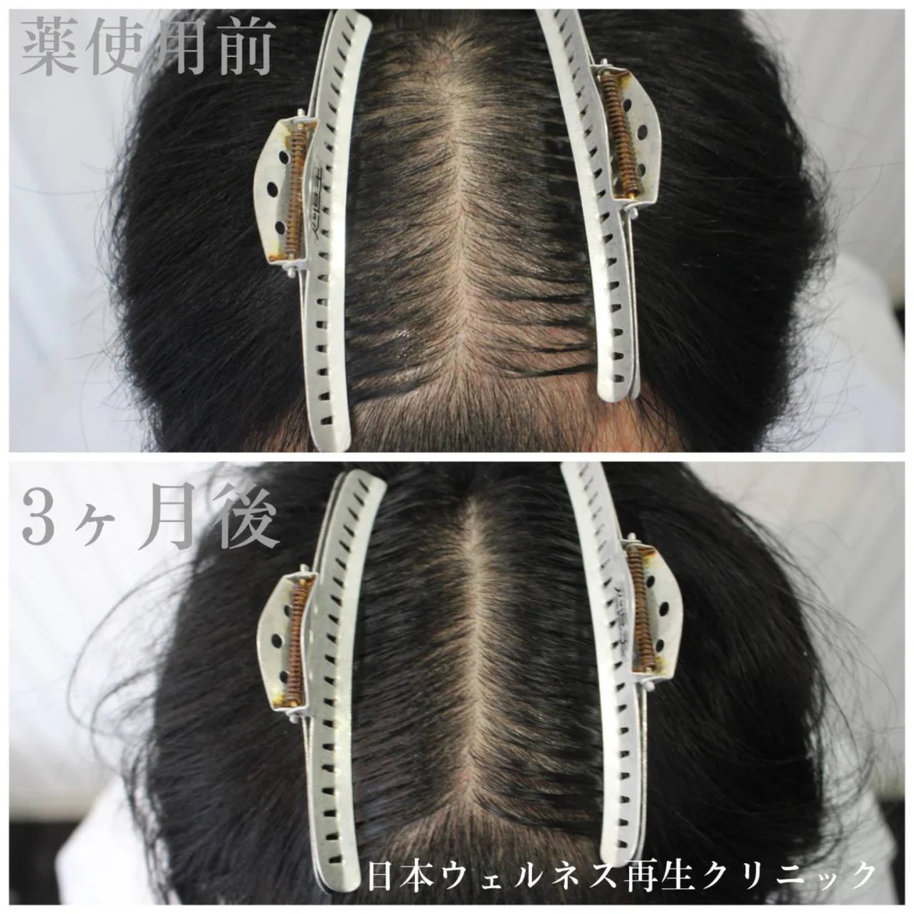 AGA薬剤治療に関する解説画像