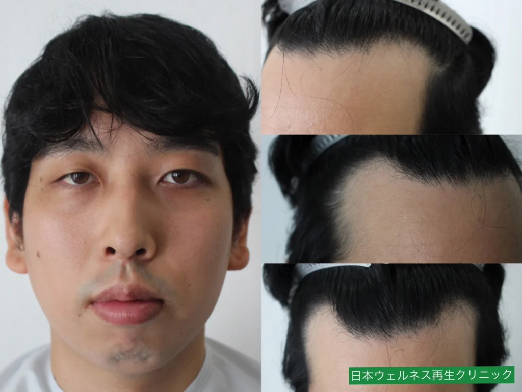 K・Tさんのオペ前
