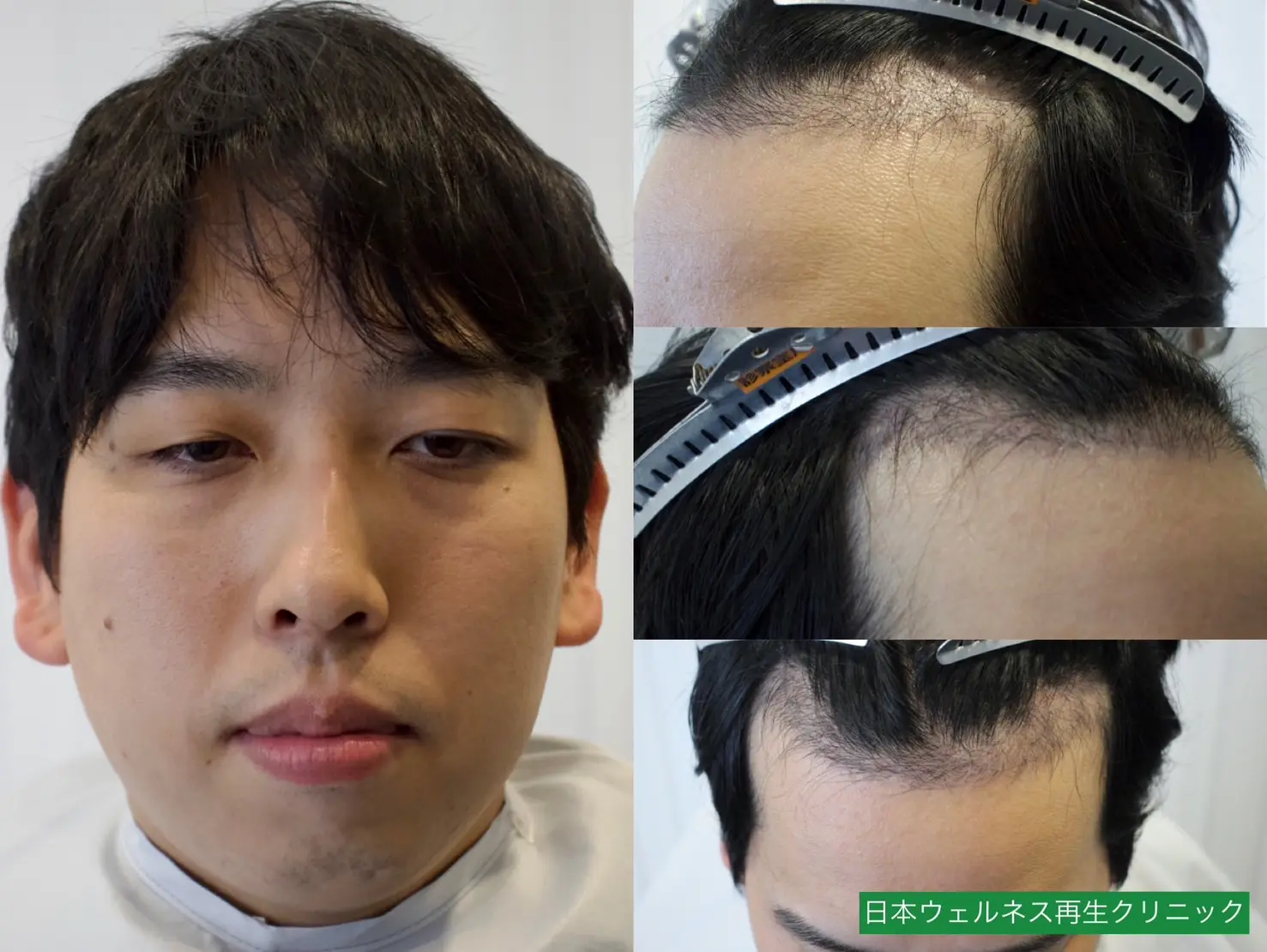 K・Tさんのオペ後3ヶ月