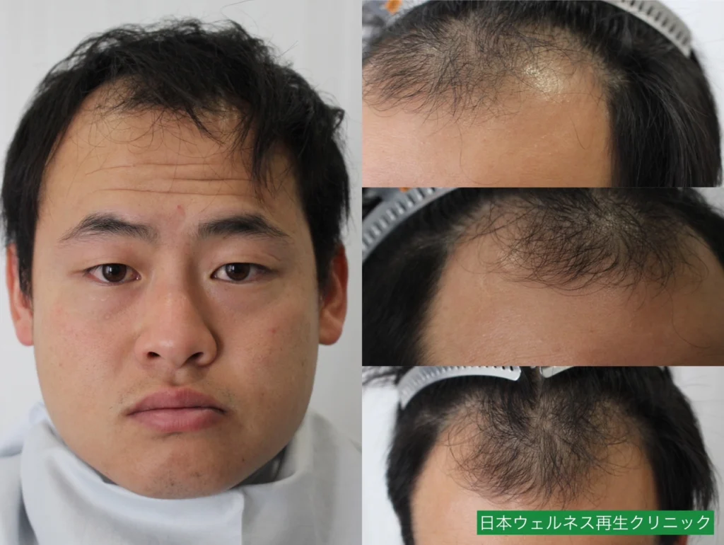 M・Tさんのオペ前