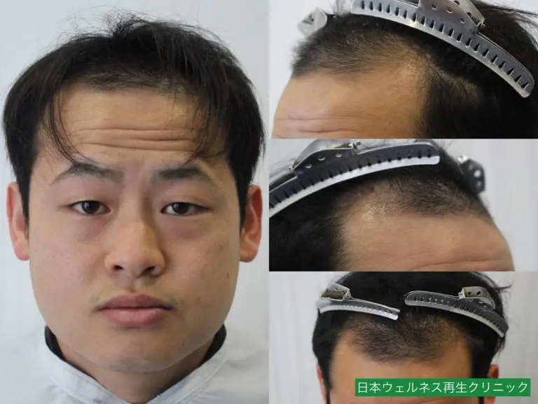 M・Tさんのオペ後3ヶ月