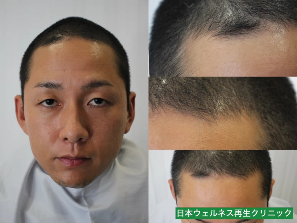 N・Nさんのオペ前