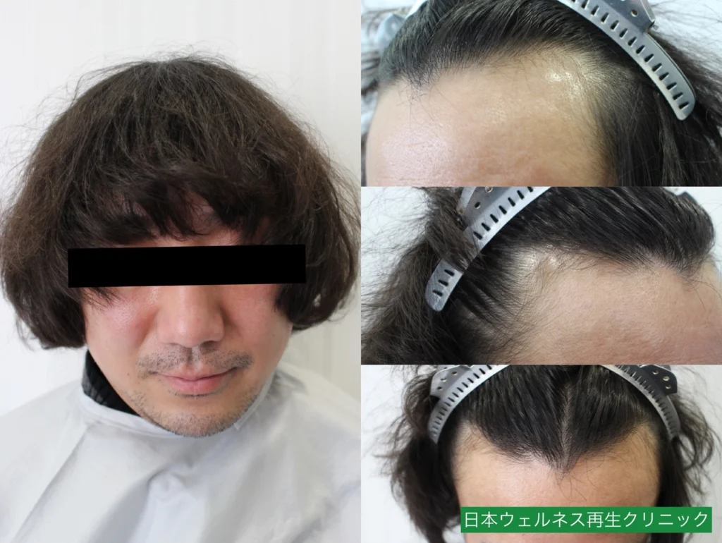 N・Sさんのオペ前