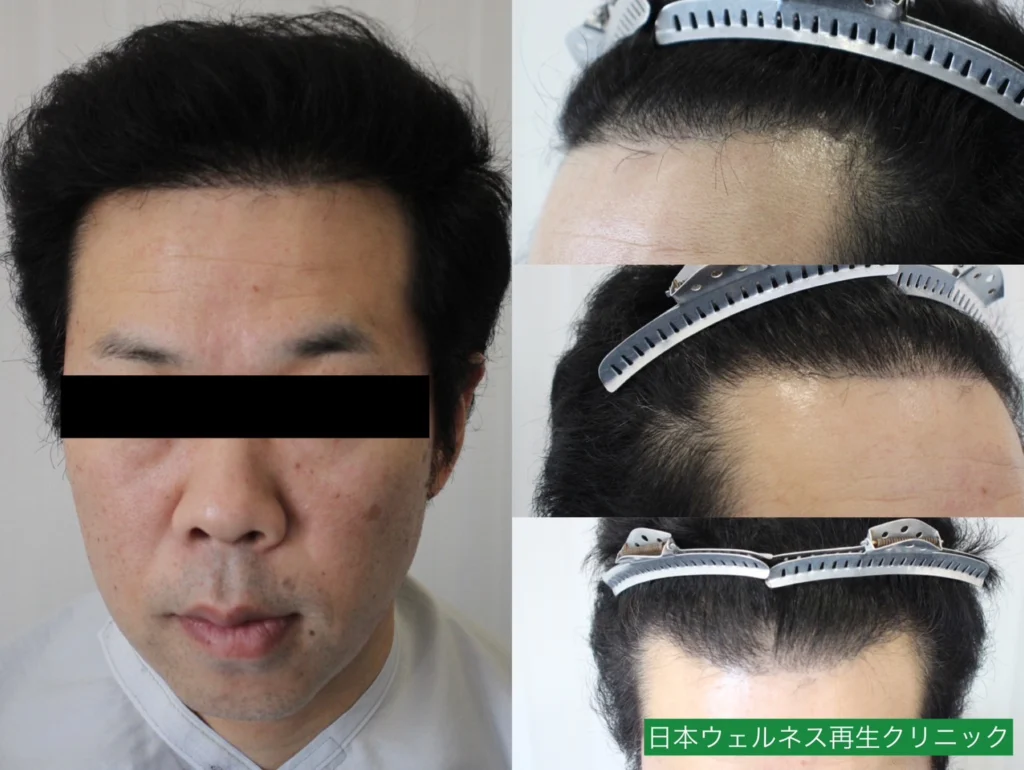 T・Oさんのオペ6ヶ月後