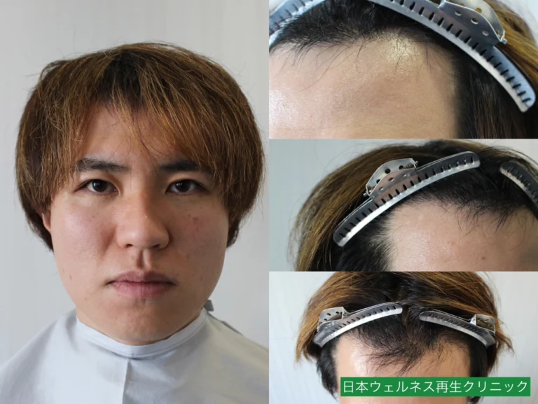 H・Iさん 30代男性 FUE 1100株の症例写真