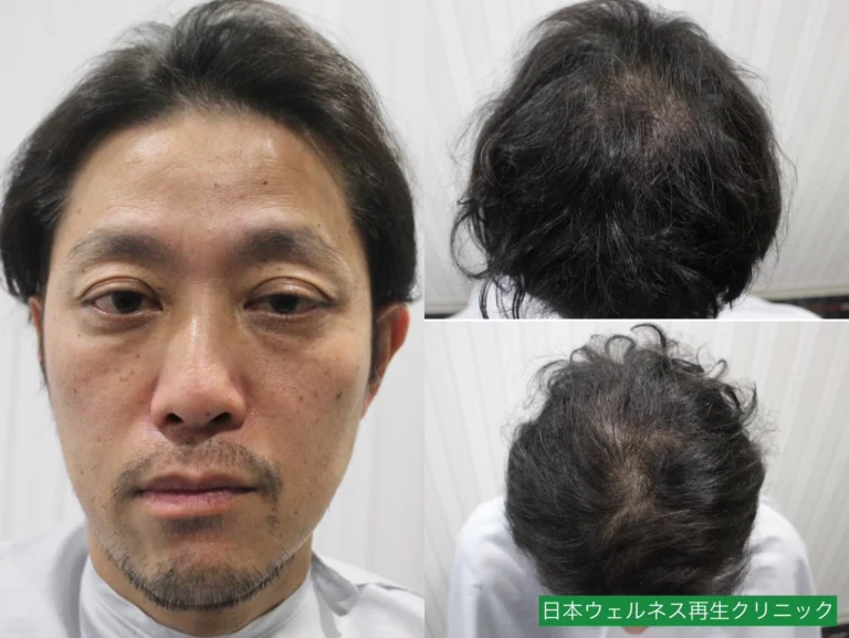 K・Hさん 40代男性 FUT 1300株の症例写真