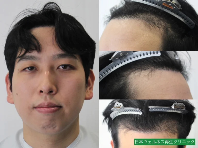 K・Tさん 20代男性 FUE 1000株の症例写真