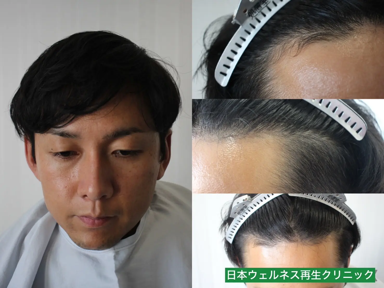 N・Nさん 30代男性 FUE 1300株の症例写真