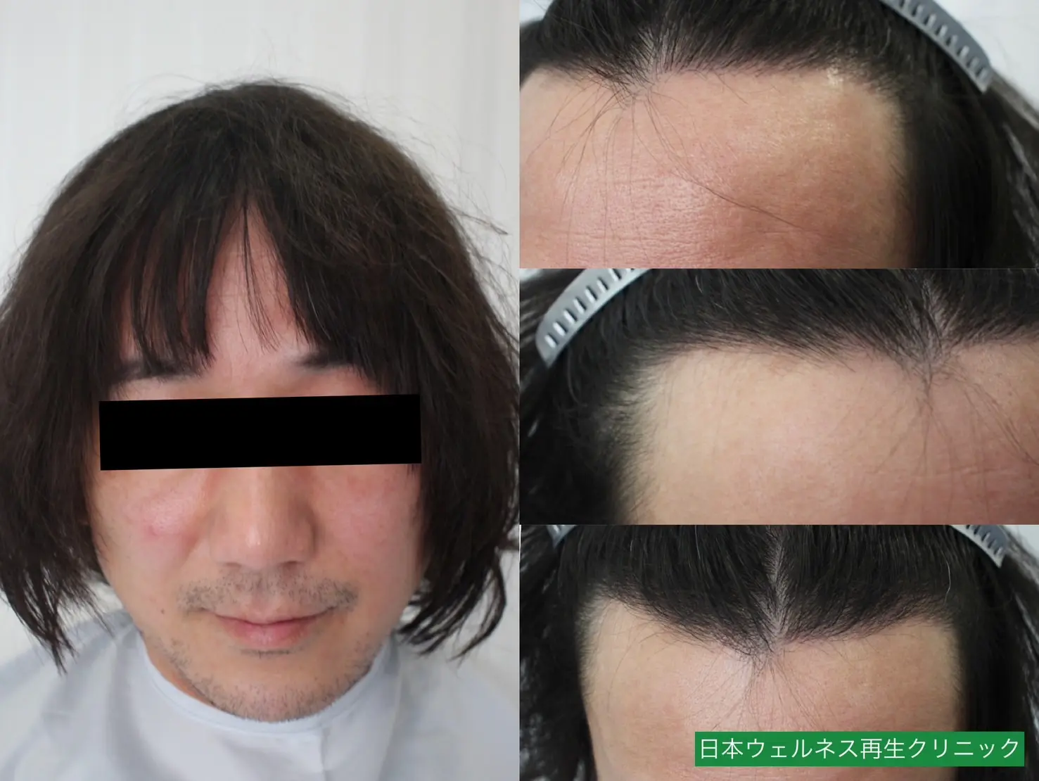 N・Sさん 40代男性 FUT 500株の症例写真