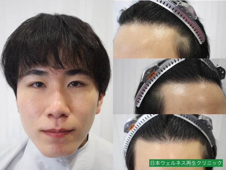S・Nさん 20代男性 FUT 1300株の症例写真