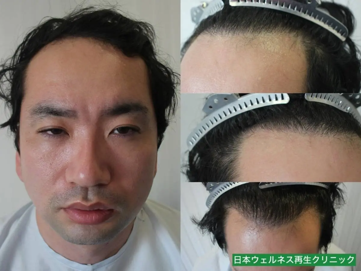 Y・Aさん 30代男性 FUT 1500株の症例写真