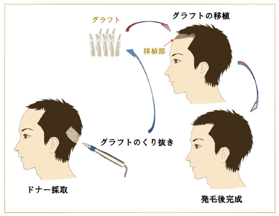 FUE法でドナーを採取しグラフトを移植する流れの図解