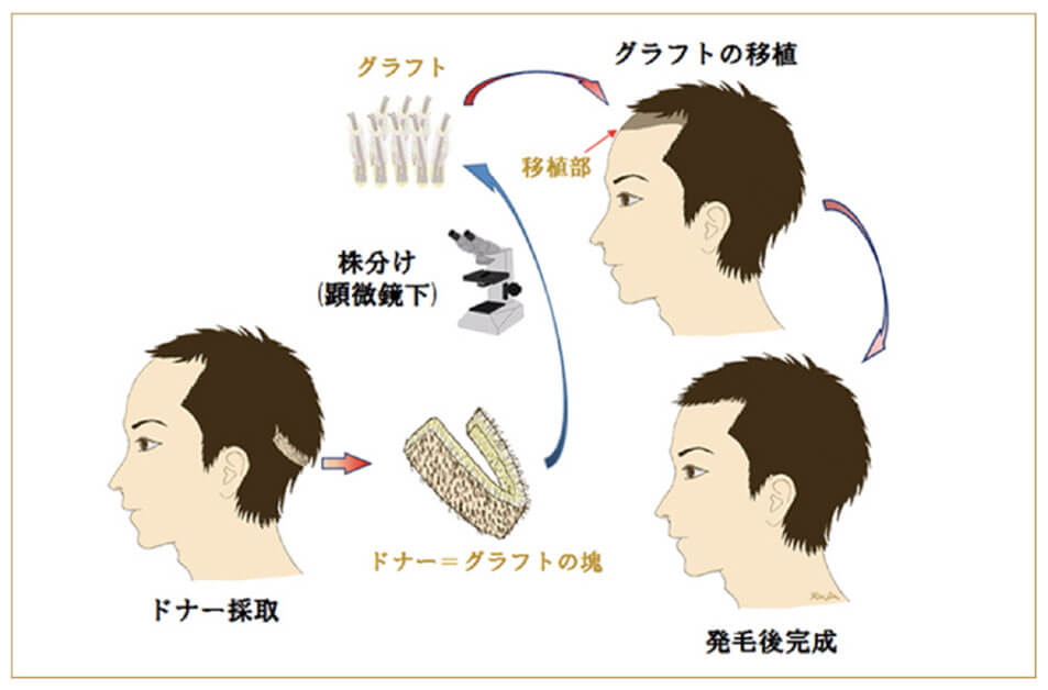 山本式FUT法でドナーを採取し株分けして移植する流れの図解