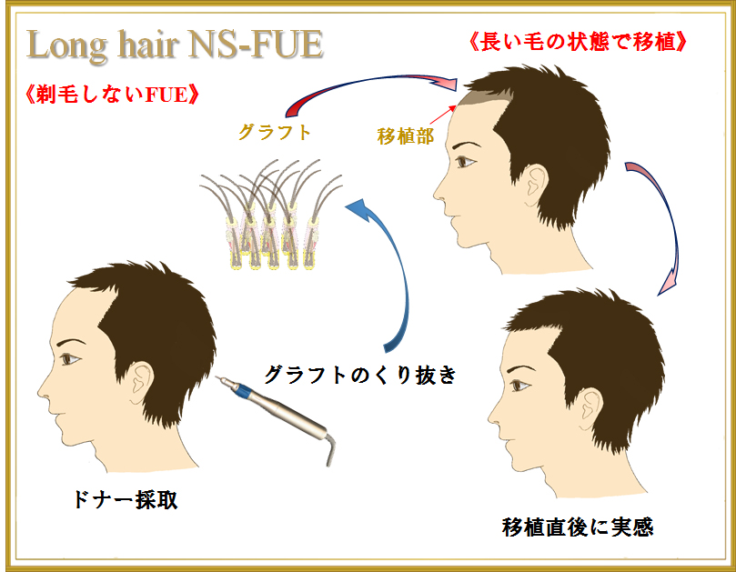Long Hair NS-FUE法で長い毛髪の状態のまま採取して移植する流れの図解