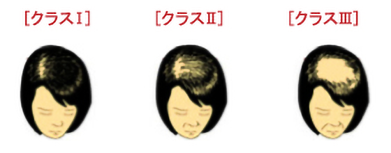 女性の頭部を示すイメージ
