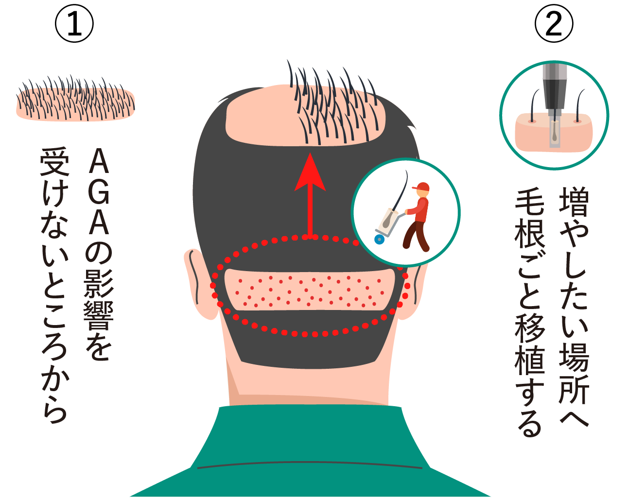 AGAの影響を受けにくい後頭部から増やしたい場所へ毛根ごと移植する自毛植毛のイメージ