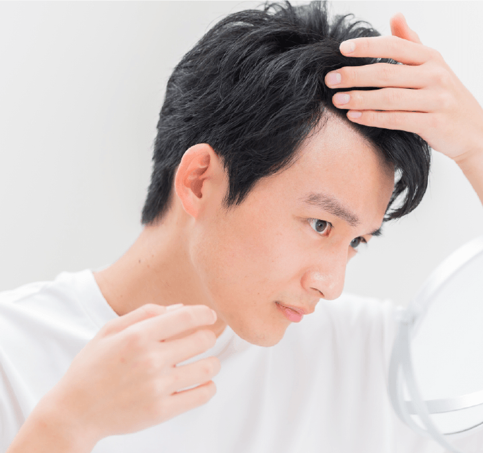 生え際の薄毛に悩む男性のイメージ